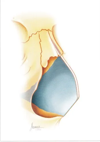 Hogyan műanyag Hogyan műanyag