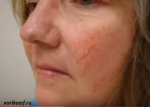 rosacea kozmetikumok rosacea kozmetikumok