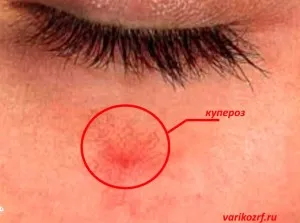 rosacea kozmetikumok rosacea kozmetikumok