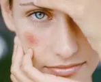 rosacea kozmetikumok rosacea kozmetikumok