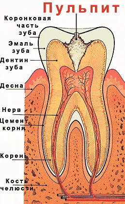 Mi a kezelése fogbélgyulladás