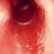 metaplasia
