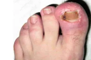 Tályog az orr kezelésére
