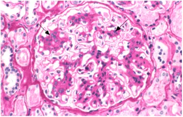 Hogyan és mit idült pyelonephritis Hogyan és mit idült pyelonephritis