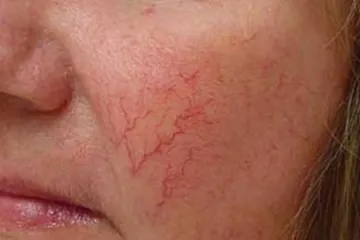 rosacea kozmetikumok