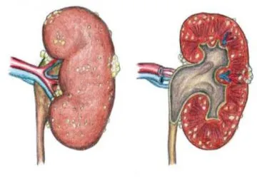 Hogyan és mit idült pyelonephritis Hogyan és mit idült pyelonephritis
