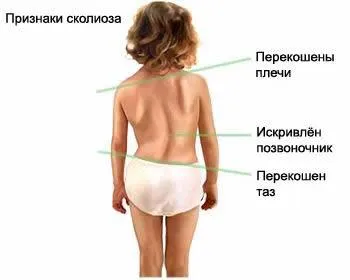 Mik a jelei osteochondrosis