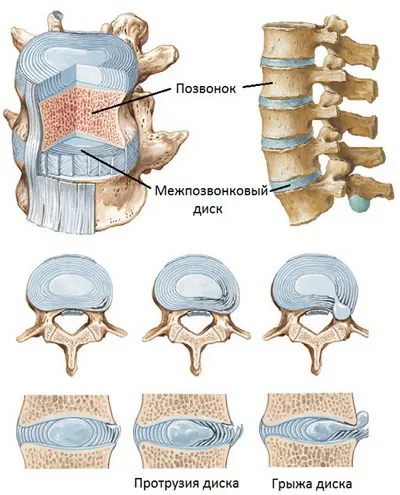 Mik a jelei osteochondrosis Mik a jelei osteochondrosis