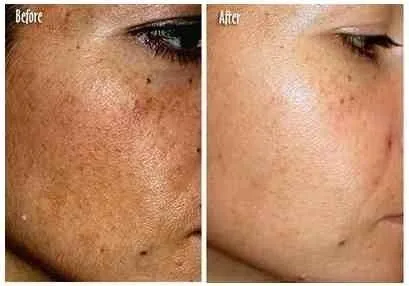 Whitening krém Whitening krém