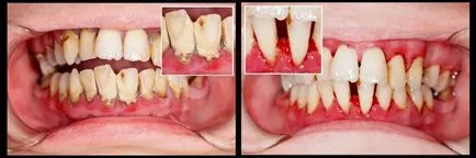 A periodontitis kórtörténet A periodontitis kórtörténet