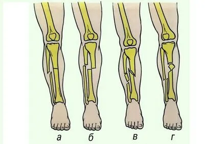 Mik a jelei osteochondrosis