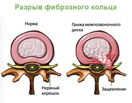 Ágyéki keresztcsonti gerinc kezelés