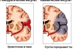 Férfiakban stroke