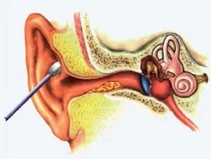 Fül, hogyan kell eltávolítani a dugót a fülbe