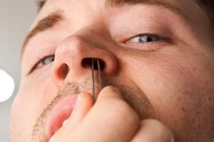 Férfiakban stroke