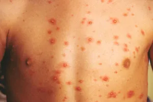 Pustules mi ez Pustules mi ez
