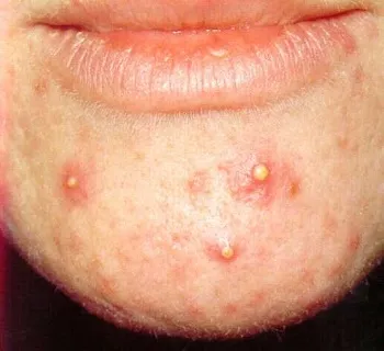 Pustules mi ez