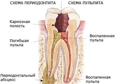 Mi a kezelése fogbélgyulladás Mi a kezelése fogbélgyulladás