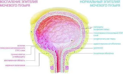 Ezért cystitis
