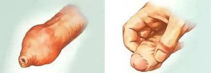Mi a heg phimosis Mi a heg phimosis