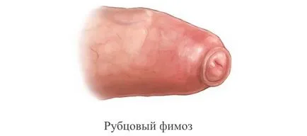 Mi a heg phimosis Mi a heg phimosis