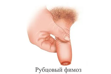 Mi a heg phimosis Mi a heg phimosis