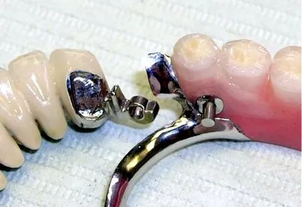 Fogsor, hogy a jobb
