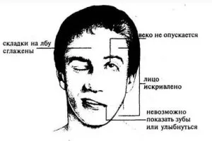 Férfiakban stroke