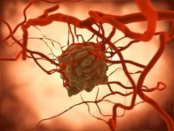 vasculitis meg