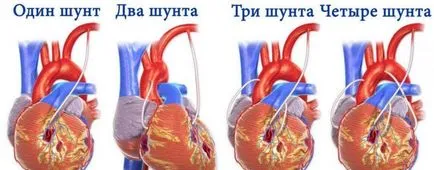 Szívkoszorúér bypass mi ez Szívkoszorúér bypass mi ez