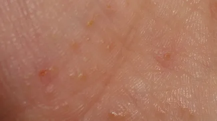 Ebből a kiütés pattanások Ebből a kiütés pattanások