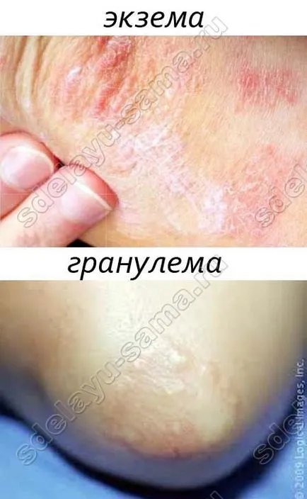 A gyermek a könyökére, mint egy kiütés A gyermek a könyökére, mint egy kiütés