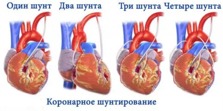 Szívkoszorúér bypass mi ez