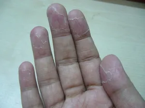 Ettől kezdve húzza le a bőrt a kézen Ettől kezdve húzza le a bőrt a kézen