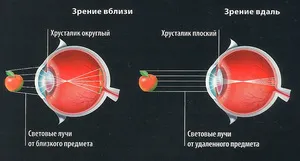 Mi cyclospasm Mi cyclospasm