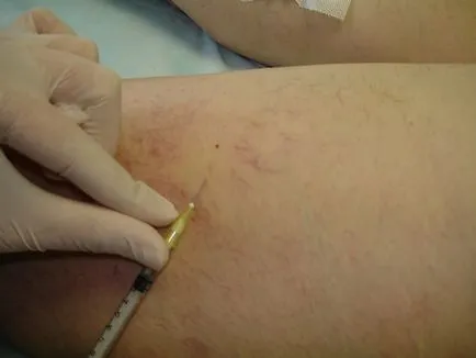 Hogyan kell kezelni seprűvénák Hogyan kell kezelni seprűvénák
