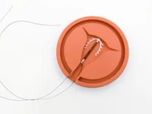 Mi az IUD eltávolítása