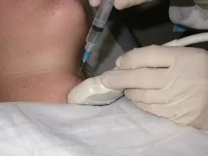 Tűbiopszia a pajzsmirigy Tűbiopszia a pajzsmirigy