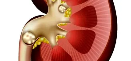 nephrocalcinosis