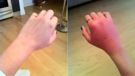Ha megharapott egy macska