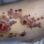 vasculitis meg vasculitis meg
