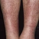 vasculitis meg vasculitis meg