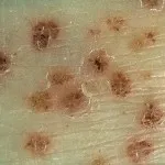 vasculitis meg vasculitis meg