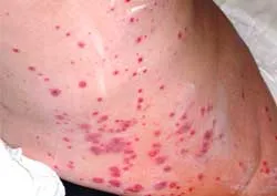 vasculitis meg