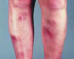 vasculitis meg