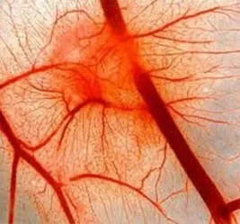 vasculitis meg