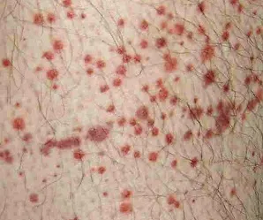 vasculitis meg