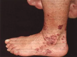 vasculitis meg vasculitis meg