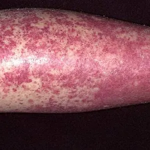 vasculitis meg vasculitis meg
