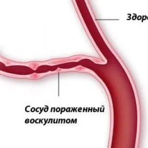 vasculitis meg vasculitis meg